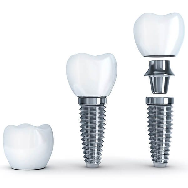 Infographic of the composition of a dental implant